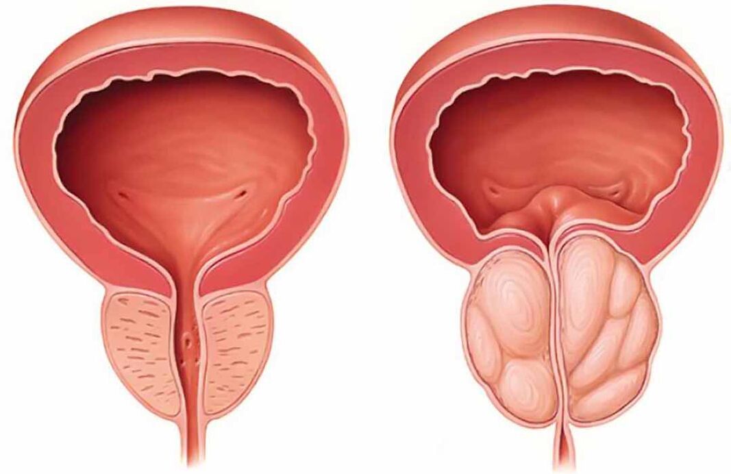 Normální prostata a zánět prostaty (chronická prostatitida)