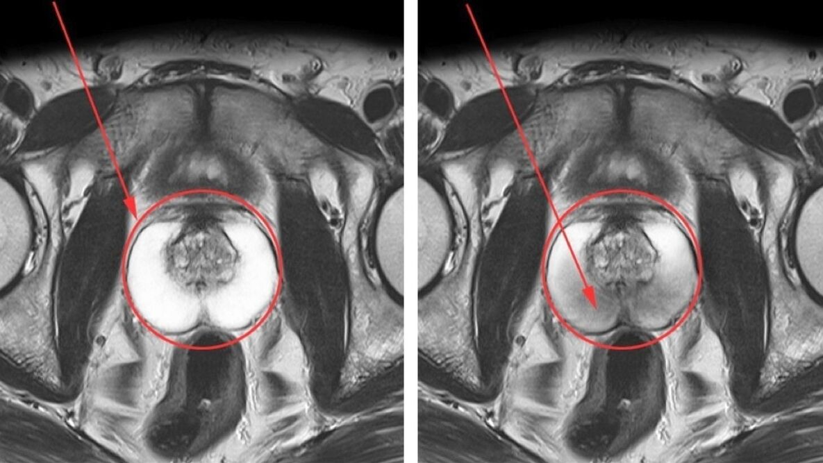Ultrazvuk pro chronickou prostatitidu – zdravá prostata (vlevo) a zanícená (vpravo)