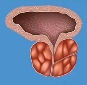 Charakteristické příznaky prostatitidy