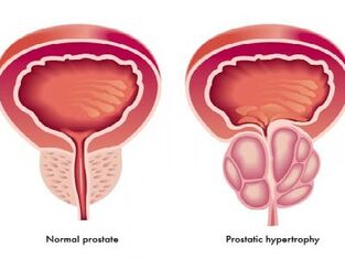 Normální a zapálená prostata