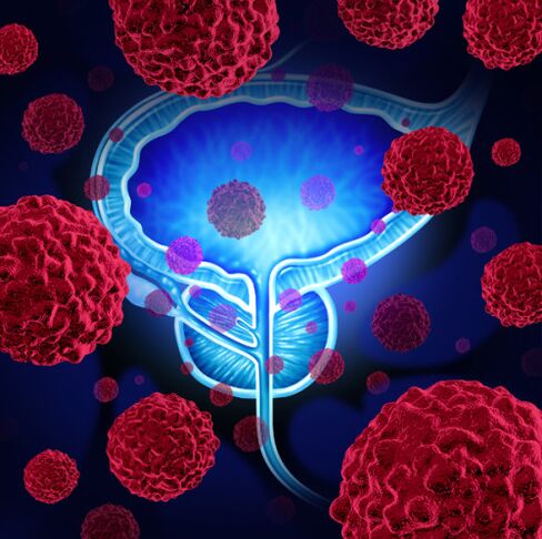 Aktivita patogenních mikroorganismů je příčinou rozvoje prostatitidy
