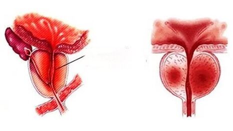 Jak vypadá chronická prostatitida